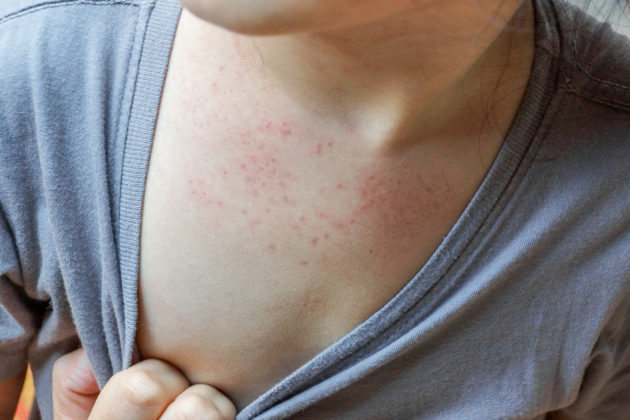 eczema-flare-up-treatment-my-blog